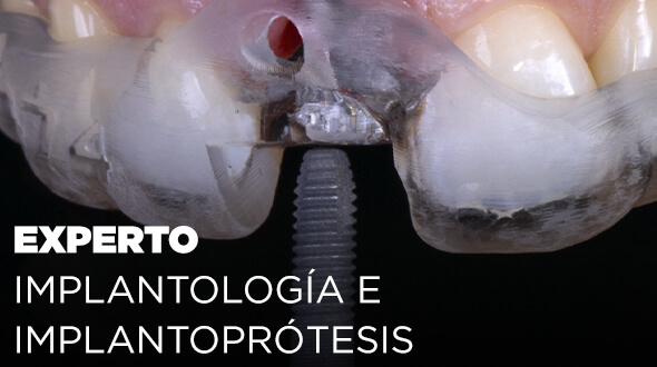 Experto Universitario en Implantología e Implanto-Prótesis