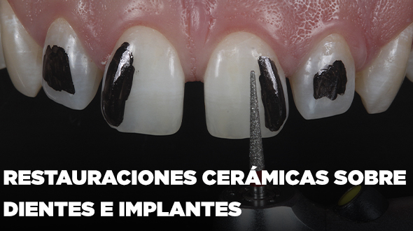 Restauraciones Cerámicas sobre dientes e implantes