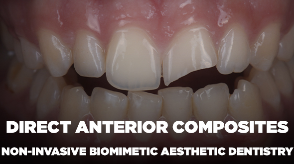 Direct Anterior Composites Course (English)