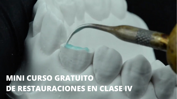 Mini curso de Restauraciones en Clase IV