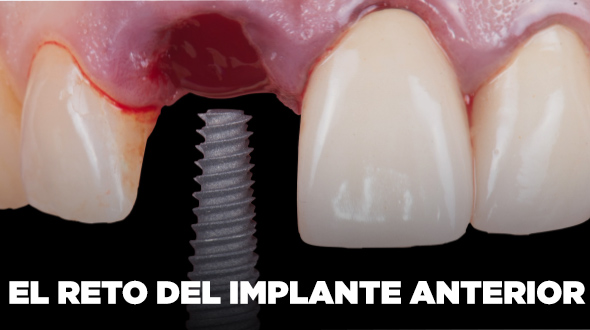 Curso El Reto del Implante Anterior