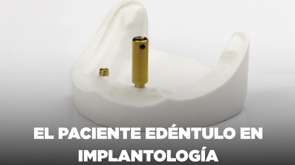 Curso El Paciente Edéntulo en Implantología – Cirugía y Prótesis