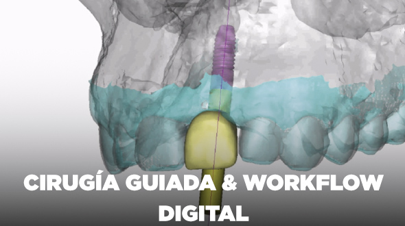Curso Cirugía Guiada y Workflow Digital en Implantología
