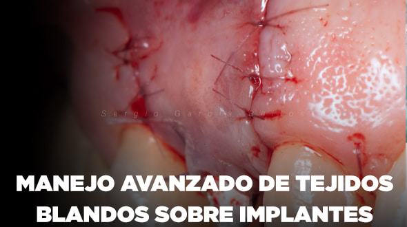 Curso El Manejo Avanzado de Tejidos Blandos en Implantes