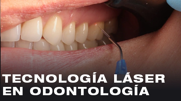 Tecnología Láser en Odontología
