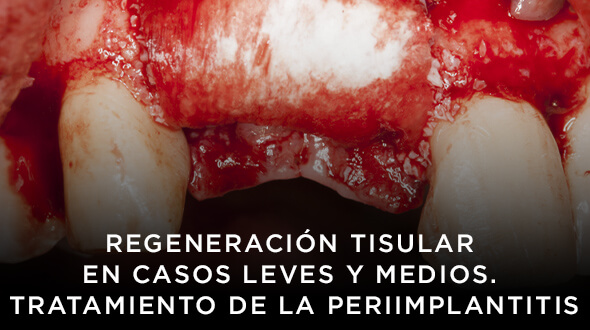 Curso Regeneración Tisular en casos leves y medios