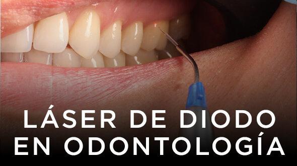Curso Láser de Diodo en Odontología
