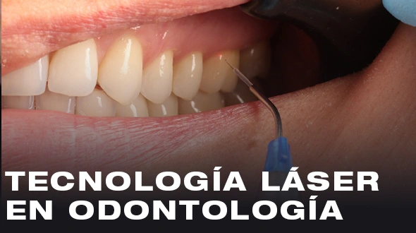 Imagen Tecnología Láser en Odontología