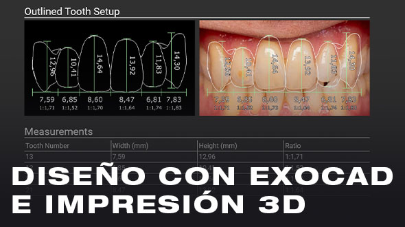 Curso de Diseño con Exocad e Impresión 3D