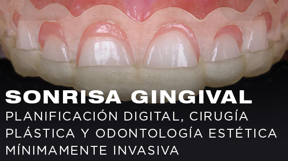 Curso Sonrisa Gingival: Planificación Digital, Cirugía Plástica y Odontología Estética Mínimamente Invasiva