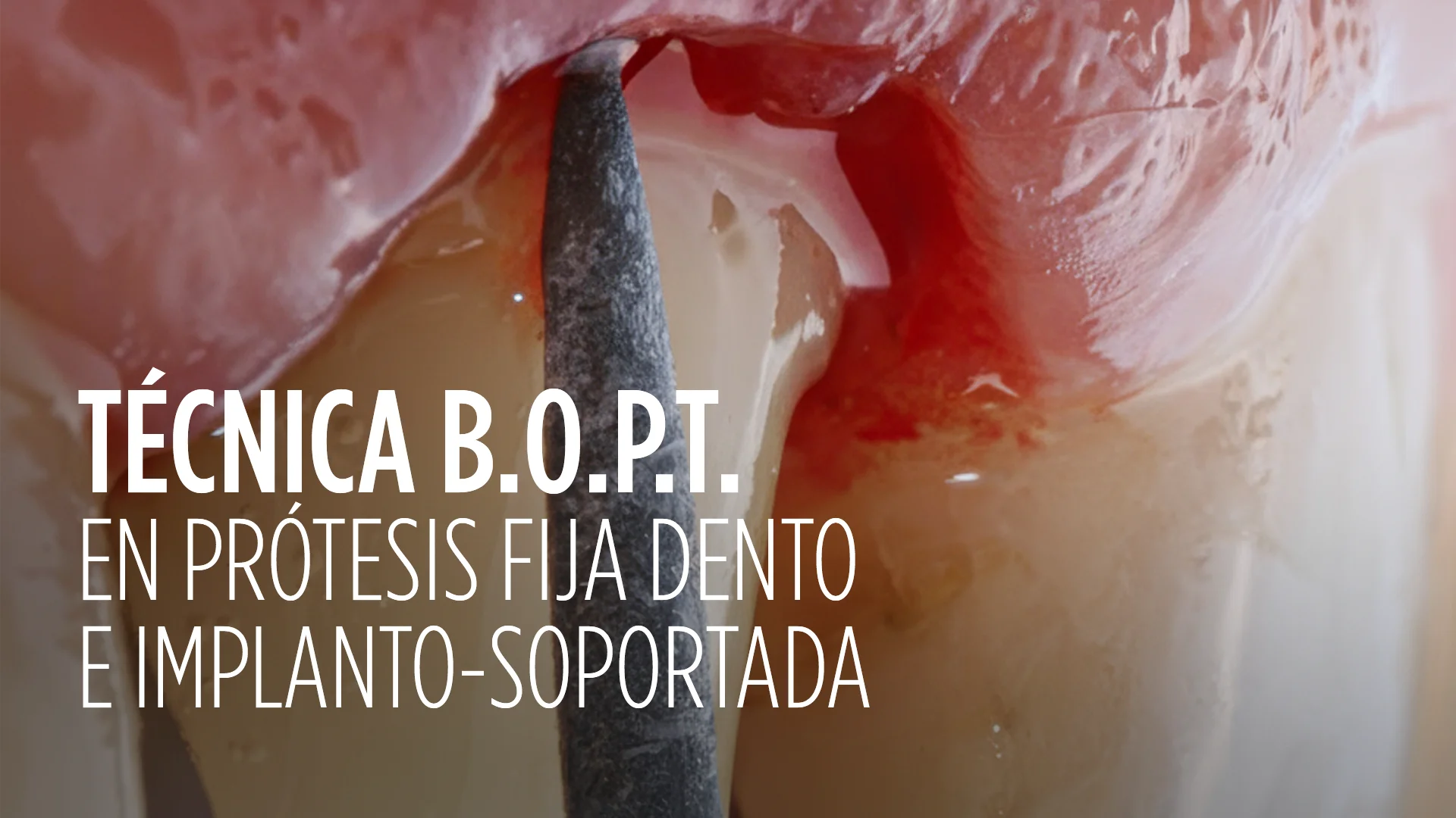Técnica B.O.P.T. en Prótesis Fija Dento e Implanto-Soportada